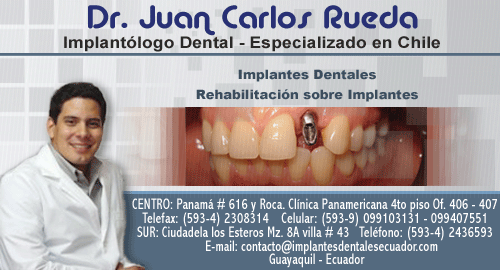 Implantes dentales guayaquil ecuador